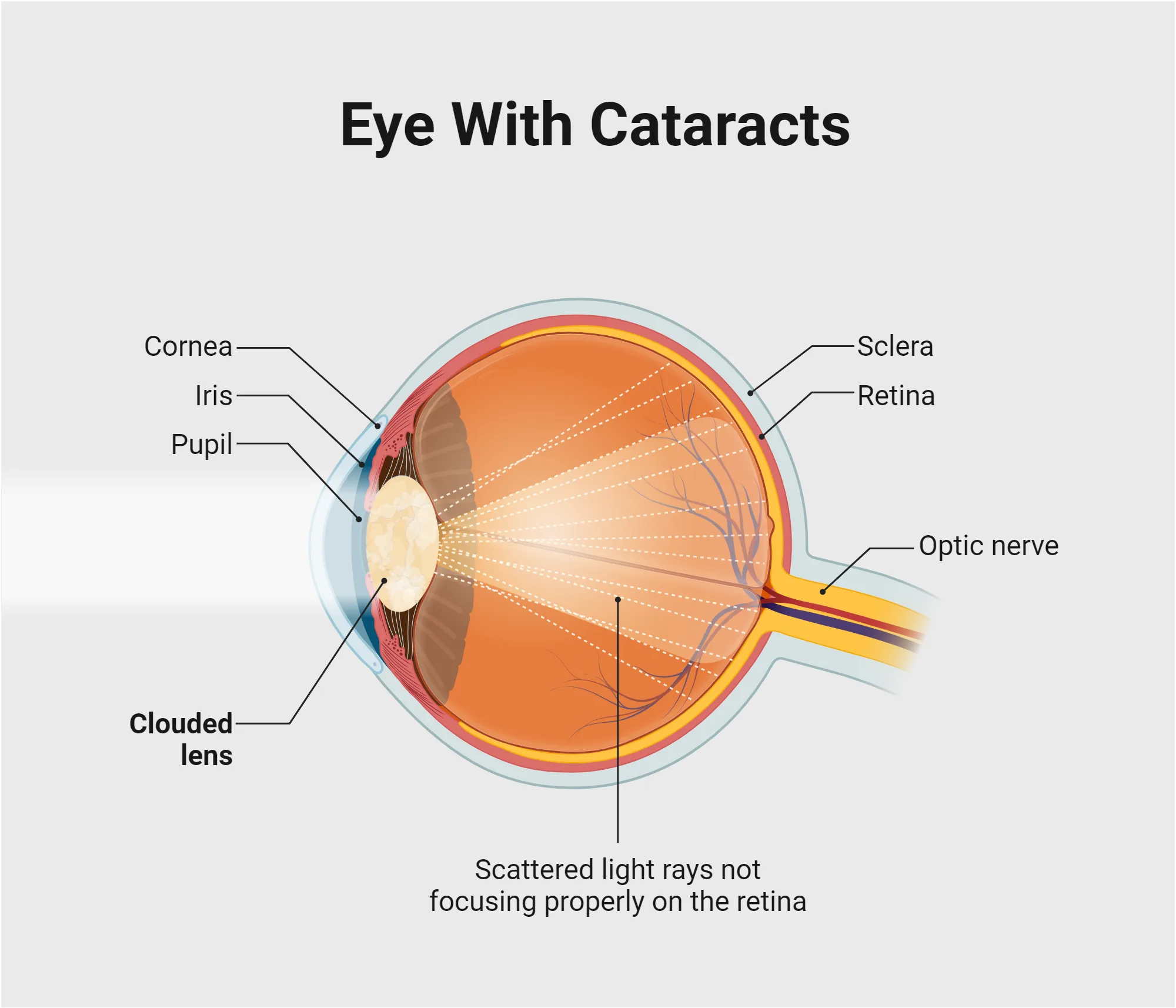 Cataract Treatment