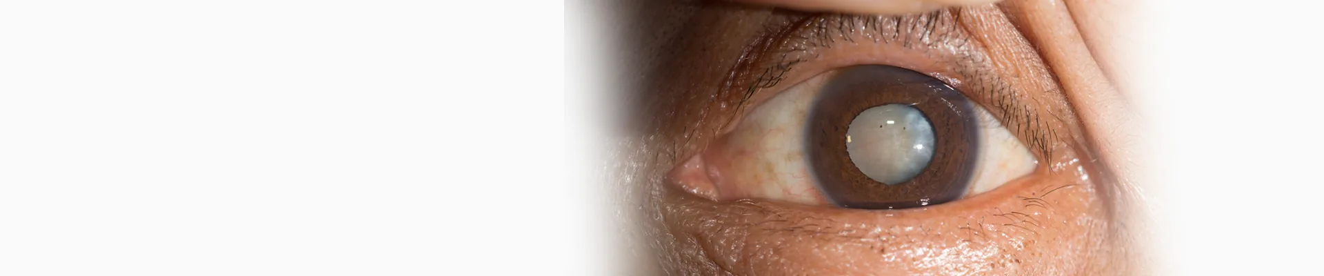 Cataract Services Banner