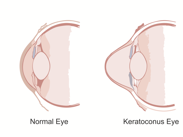 Keratoconus eye-min