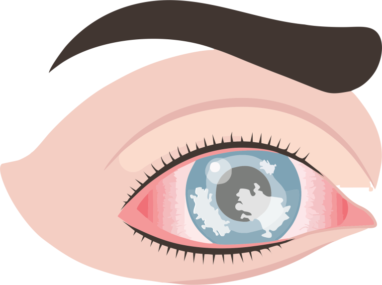 corneal-dystrophy-min